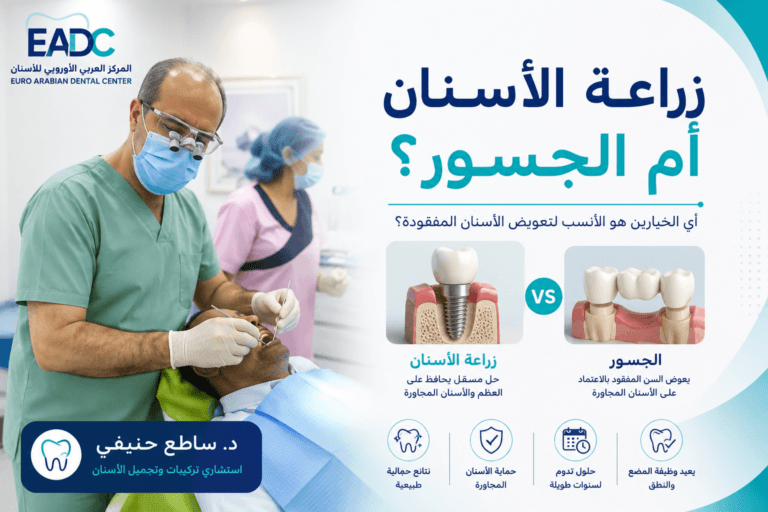 زراعة الأسنان أم الجسور؟ مقارنة شاملة لاختيار العلاج المناسب في سلطنة عمان