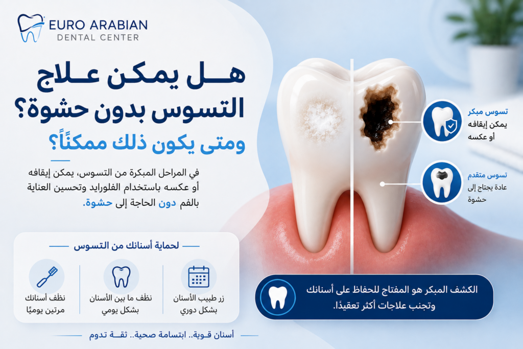 هل يمكن علاج التسوس بدون حشوة؟ توضيح مراحل تسوس الأسنان والعلاج المبكر