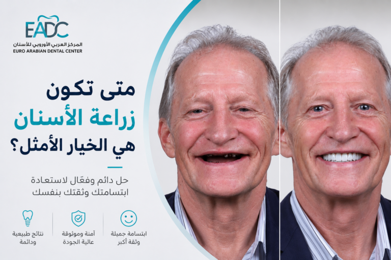 متى تكون زراعة الأسنان الخيار الأفضل لاستبدال الأسنان المفقودة؟