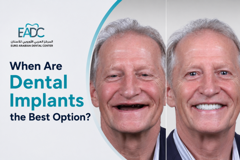 Dental implant replacing a missing tooth to restore a natural-looking smile at Euro Arabian Dental Center.